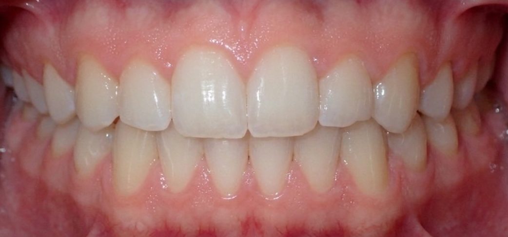 Vivid Smiles patient case 2 before and after treatment comparison after